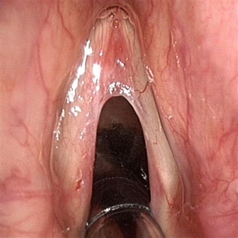 Anterior Commissure Web Formed After Suspension Microlaryngoscopic