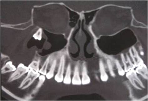 Ectopic Tooth In The Orbital Floor An Unusual Case Of Dentigerous Cyst