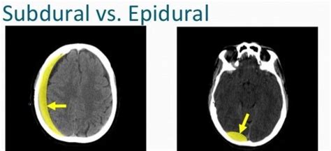 Difference Between Subdural And Epidural