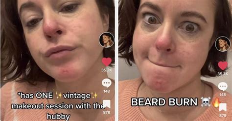Women Are Speaking Up About Chin Infections From Kissing Their Bearded
