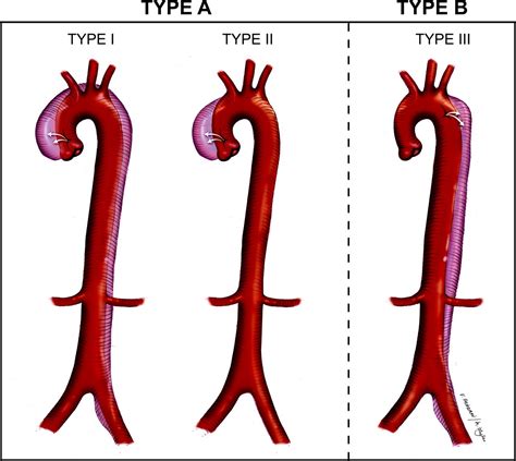 Acute Aortic Dissection Circulation