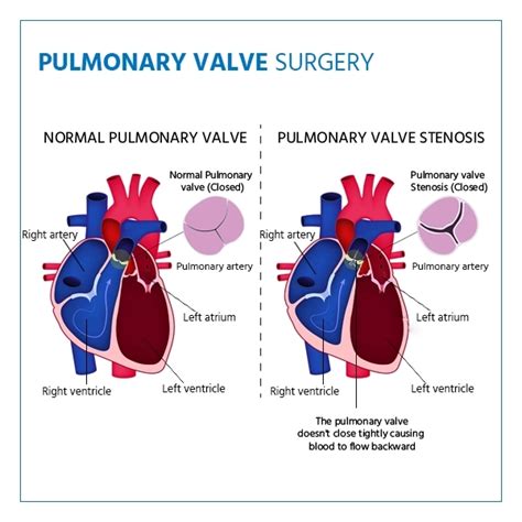Pulmonary Valve Surgery Recovery Lifestyle Changes