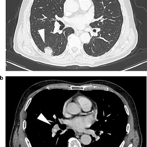 The Extent Of Lobespecific Complete Mediastinal Lymph Node Dissection