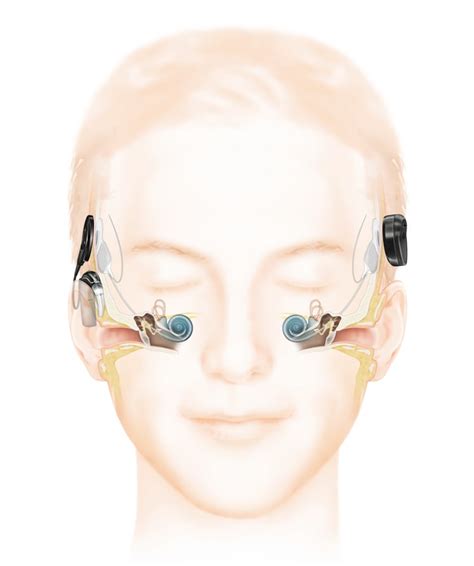 Wie Das Hören Mit Einem Cochlea Implantat Funktioniert Cochlear