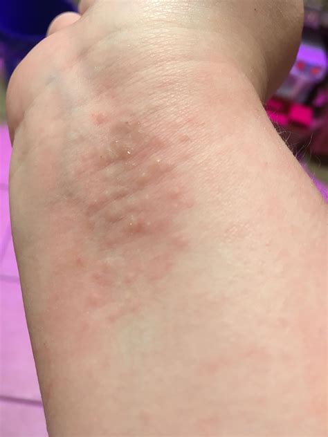 What Is This Rash On My Wrist Dog Breeds Picture