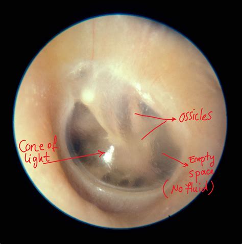 Mastoiditis Symptoms