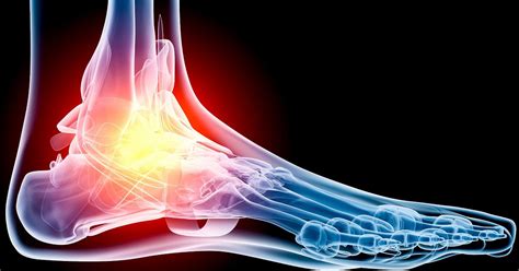 Common Running Injuries Foot Pain