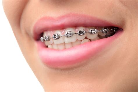 7 Fascinating Braces Facts You Should Know Onlinehealthmedia