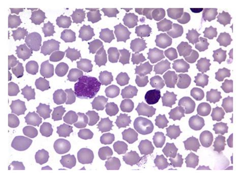 A Flower Cell In The Peripheral Smear Characteristic Of Atl Download