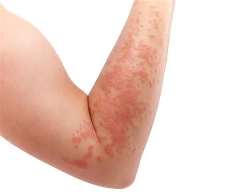 Understanding And Managing Skin Rashes Causes Symptoms Treatments