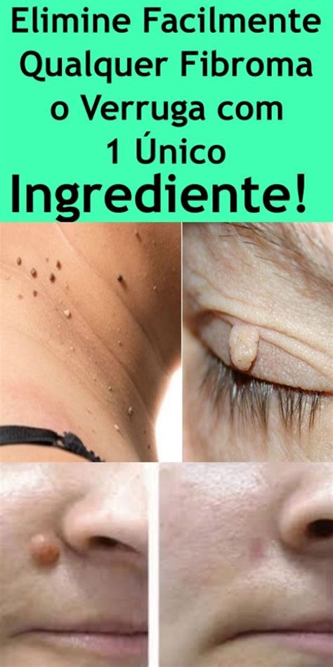 Elimine Facilmente Qualquer Fibroma o Verruga com 1 Único Ingrediente