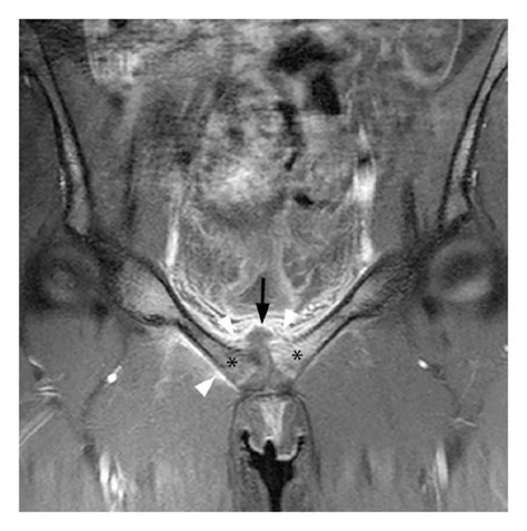 Corresponding Coronal Mr Images Of The Pubic Symphysis A T2 Weighted