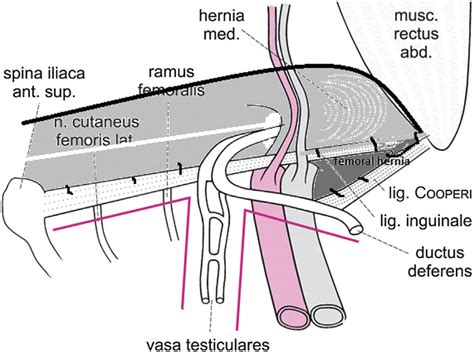 The Mesh Is Sutured To The Coopers Ligament First And To The Inguinal