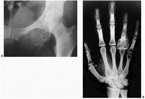 Bone Cysts And Giant Cell Tumor Basicmedical Key
