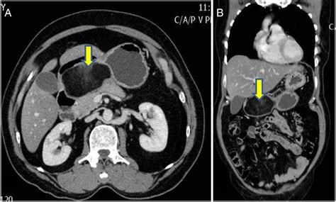 Gastric Lipoma Presenting With Haematemesis Bmj Case Reports