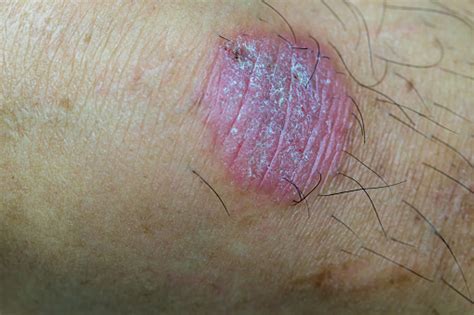 Ring Worm Infection Dermatophytosis On Skin Ringworm Infection Or Tinea