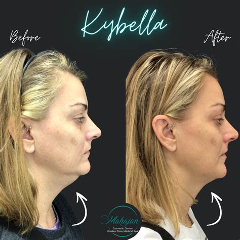 Bye Bye Stubborn Double Chin 👋🏼 We Treated This Beauty With Kybella