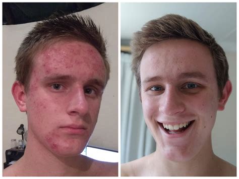 These Two Photos Were Taken Months Apart It Only Took Months Of Accutane To Make My Face