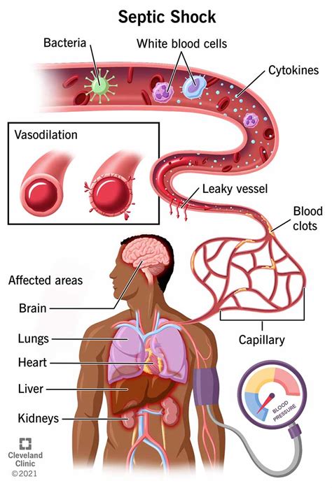 Septic Shock Causes Symptoms And Treatment