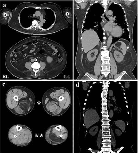 A Muscle Ct Scan Axial Images Of The Thorax Upper Abdomen Lower