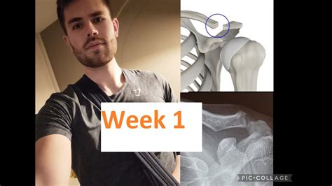 Road To Recovery Distal Clavicle Excision Surgery Week 1 Youtube
