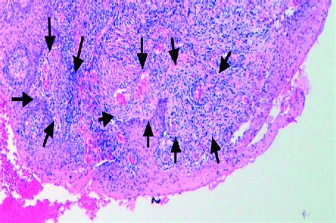 This initial stage is followed by suppression of the immune system. Histological images of the pyogenic granuloma showing an ...