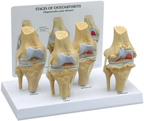 4 Stage Osteoarthritis Knee Model Gpi 1100