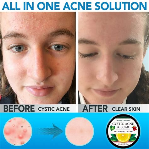 Cystic Acne And Scar Treatment Cream Antibacterial Exfoliation Etsy
