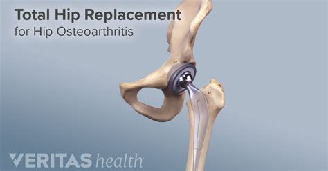 Total Hip Replacement Surgical Procedure Hip Replacement Joint