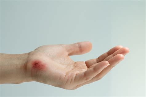 Premium Photo Scratch Wound On Female Hand Closeup Healthcare And