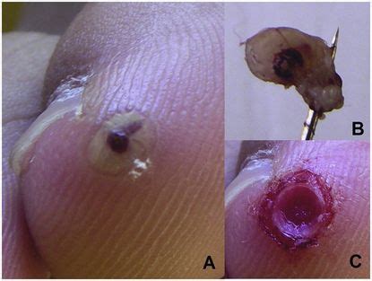 Tungiasis And Bed Bugs Oncohema Key