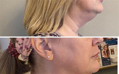 Agnes Rf Double Chin Removal Archives Align Injectable Aesthetics