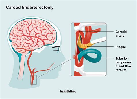 Carotid Endarterectomy Faqs Procedure Uses Recovery Risks