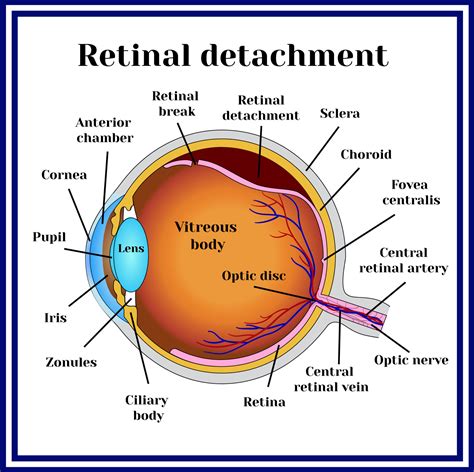 Retinal Tear And Detachment Retina Vitreous Consultants Inc