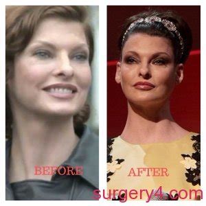 Linda Evangelista Plastic Surgery Photos Before After Surgery4