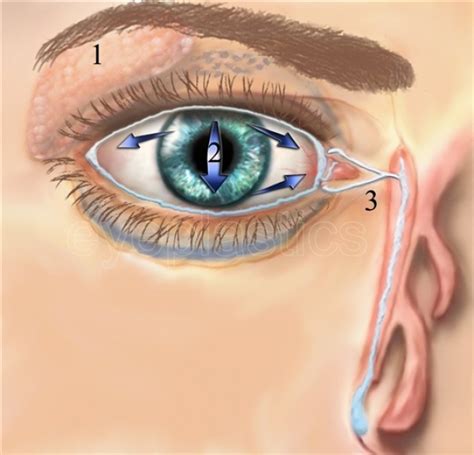 Blocked Tear Duct Nasolacrimal Duct Obstruction