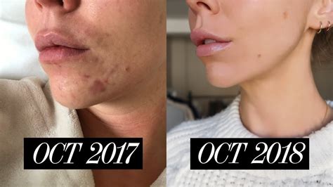 HOW TO GET RID OF ACNE Roaccutane Isotretinoin Experience Before After Tips YouTube
