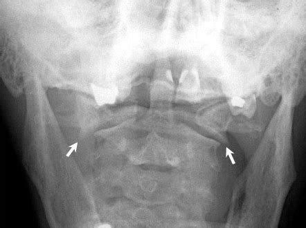 Atlas Fractures Transverse Ligament Injuries Spine Orthobullets