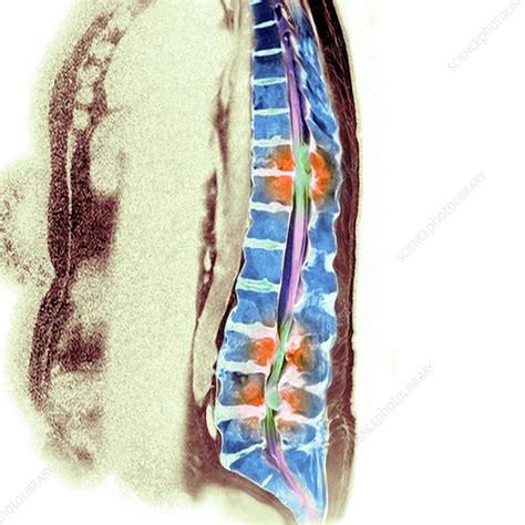 Secondary Bone Cancer Mri Scan Stock Image M1340787 Science