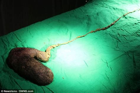 Indian Woman Has 2lb Hairball Removed From Her Stomach Daily Mail Online