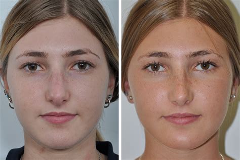 Rhinoplasty Nose Surgery Nose Job For Women In New York City David