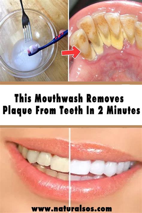 Pin On Oral Health
