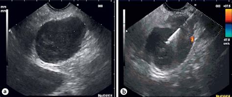 Endoscopic Ultrasound Image Of The Hypoechoic Mass A And Its Fine
