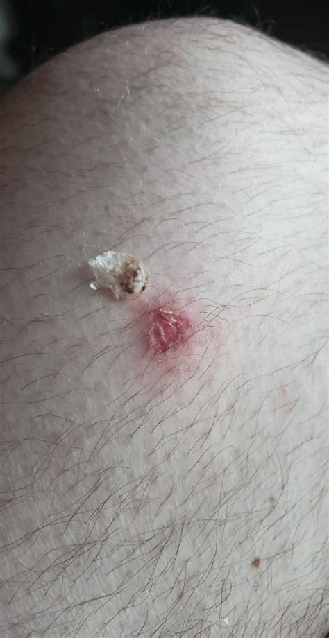 Had This Wart On My Leg For A Year Four Days Of Compound W And It Just