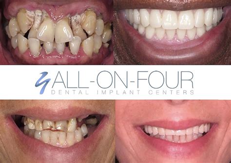 All On Four Dental Implant Procedure Titanium Vs Metal Free Zirconia