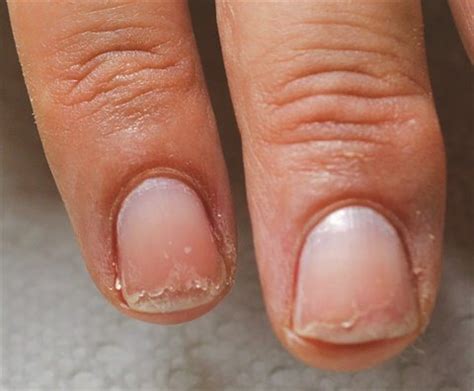 Lung disease and rheumatoid arthritis can cause yellow nails. Don't Be Daunted by Damaged Nails - Health - NAILS Magazine