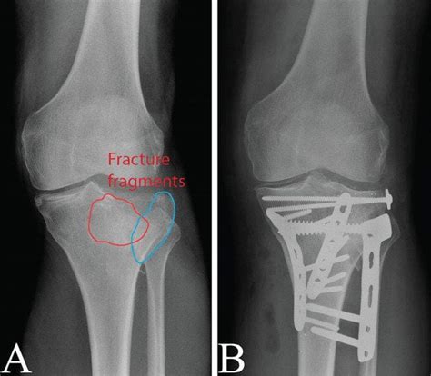 Posterior Medial Tibial Plateau Fracture