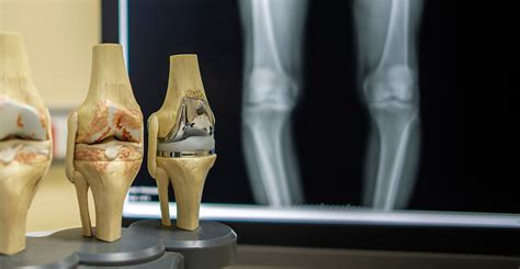 Advanced Total Knee Replacement Surgery In India At Affordable Rates