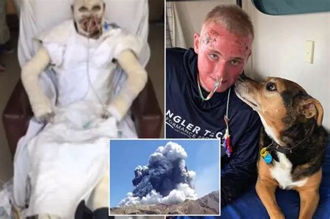 White Island Volcano Survivor Shows Horror 70 Burns After Dad And Sister Killed Daily Star