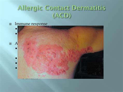 Ppt Contact Dermatitis Powerpoint Presentation Free Download Id
